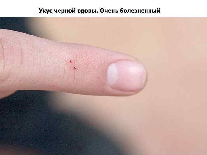 Укус черной вдовы. Очень болезненный 