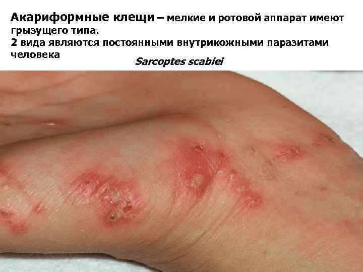 Акариформные клещи – мелкие и ротовой аппарат имеют грызущего типа. 2 вида являются постоянными