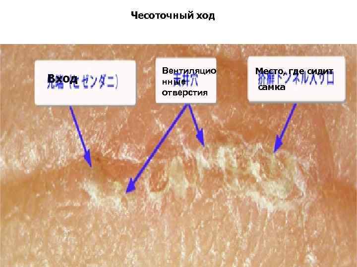 Чесоточный ход Вход Вентиляцио нные отверстия Место, где сидит самка 