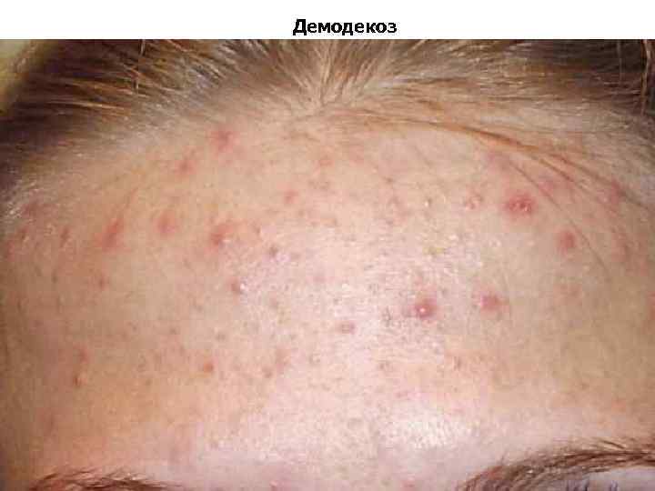 Демодекоз 