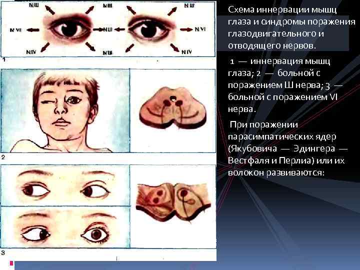 Схема иннервации мышц глаза и синдромы поражения глазодвигательного и отводящего нервов. 1 — иннервация