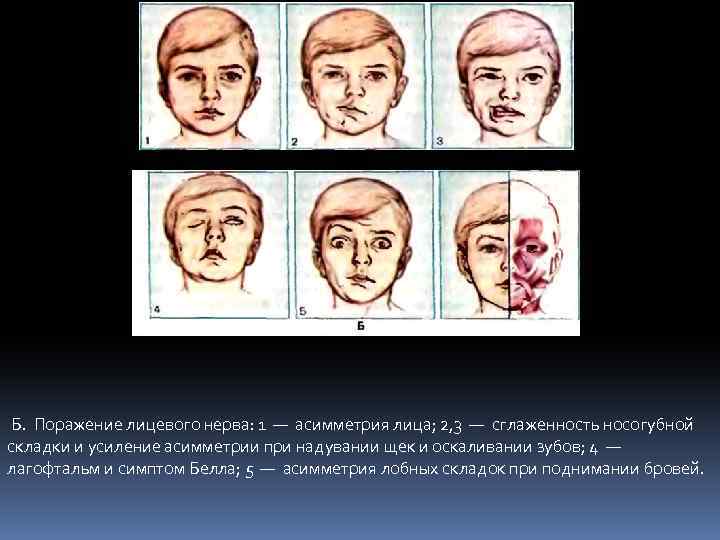  Б. Поражение лицевого нерва: 1 — асимметрия лица; 2, 3 — сглаженность носогубной