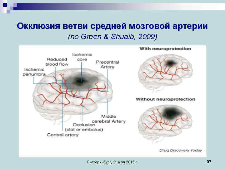 Окклюзия артерии мозга