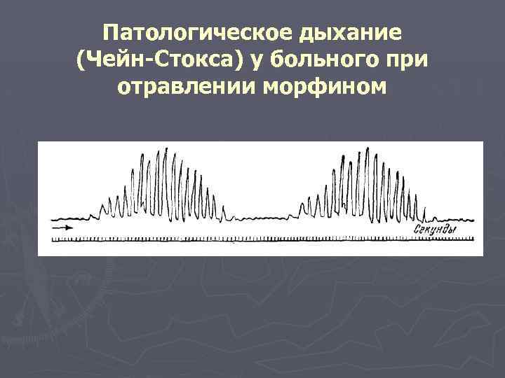 Патологическое дыхание (Чейн-Стокса) у больного при отравлении морфином 