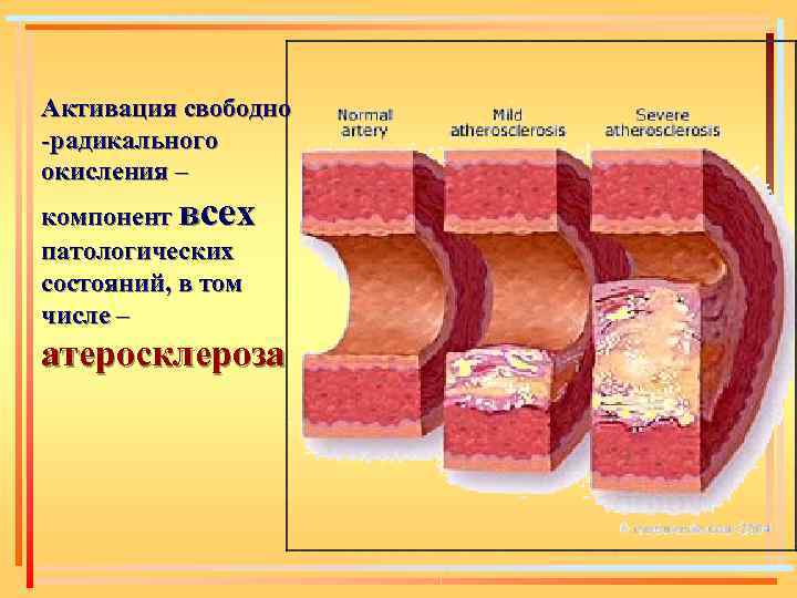 Активация свободно -радикального окисления – компонент всех патологических состояний, в том числе – атеросклероза