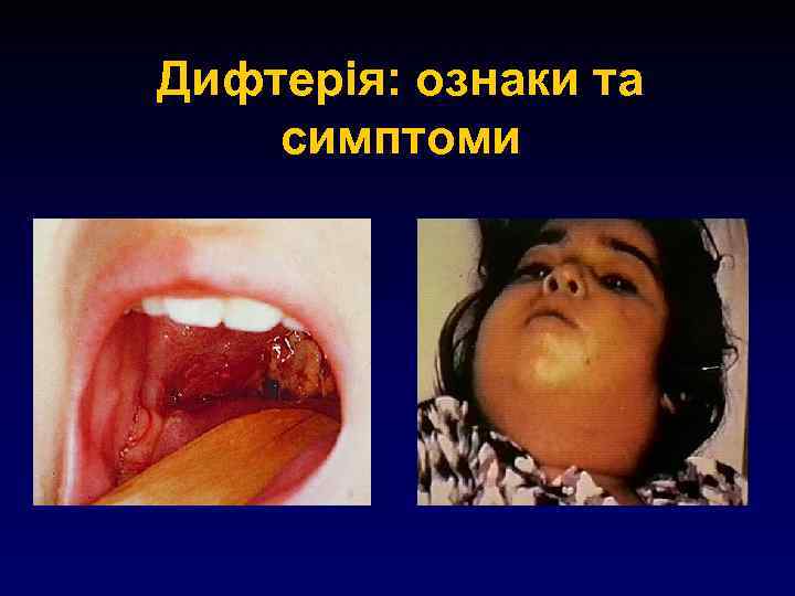 Дифтерія: ознаки та симптоми 