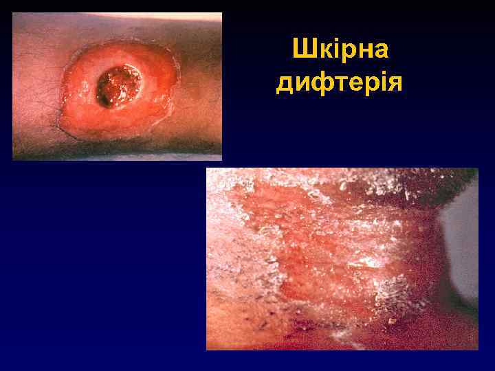 Шкірна дифтерія 