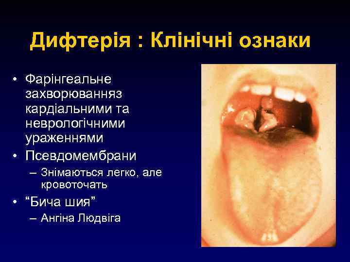 Дифтерія : Клінічні ознаки • Фарінгеальне захворюванняз кардіальними та неврологічними ураженнями • Псевдомембрани –