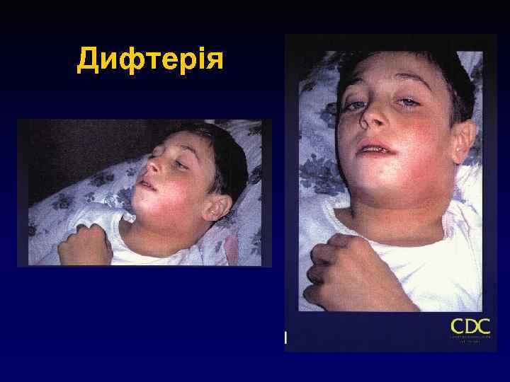 Дифтерія 