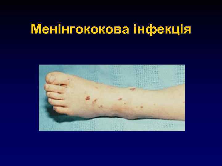 Менінгококова інфекція 