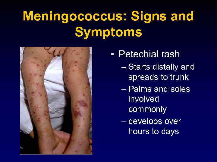 Meningococcus: Signs and Symptoms • Petechial rash – Starts distally and spreads to trunk