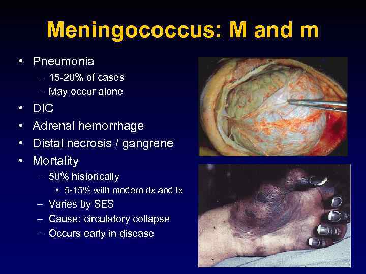 Meningococcus: M and m • Pneumonia – 15 -20% of cases – May occur