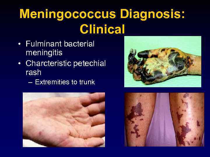Meningococcus Diagnosis: Clinical • Fulminant bacterial meningitis • Charcteristic petechial rash – Extremities to