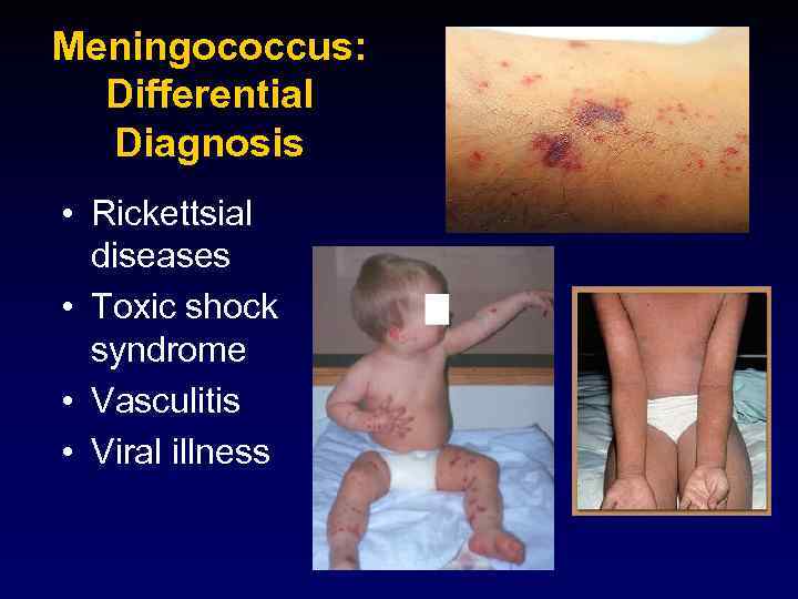 Meningococcus: Differential Diagnosis • Rickettsial diseases • Toxic shock syndrome • Vasculitis • Viral