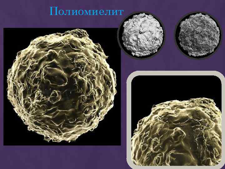Полиомиелит 