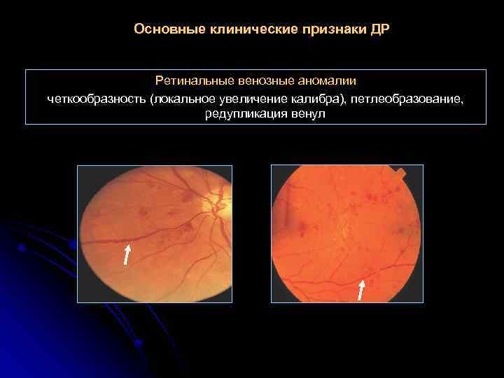 Основные клинические признаки ДР Ретинальные венозные аномалии четкообразность (локальное увеличение калибра), петлеобразование, редупликация венул