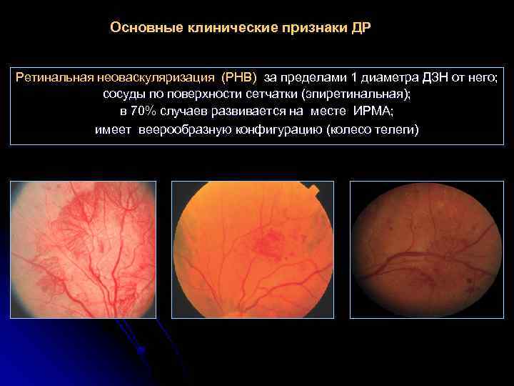 Основные клинические признаки ДР Ретинальная неоваскуляризация (РНВ) за пределами 1 диаметра ДЗН от него;