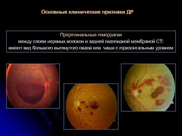 Основные клинические признаки ДР Преретинальные геморрагии между слоем нервных волокон и задней гиалоидной мембраной