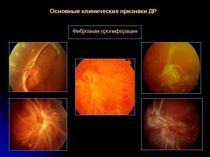 Основные клинические признаки ДР Фиброзная пролиферация 