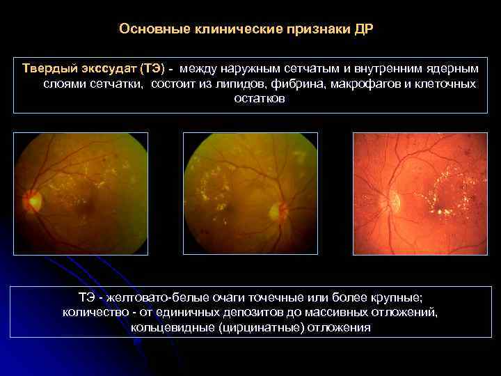 Основные клинические признаки ДР Твердый экссудат (ТЭ) - между наружным сетчатым и внутренним ядерным