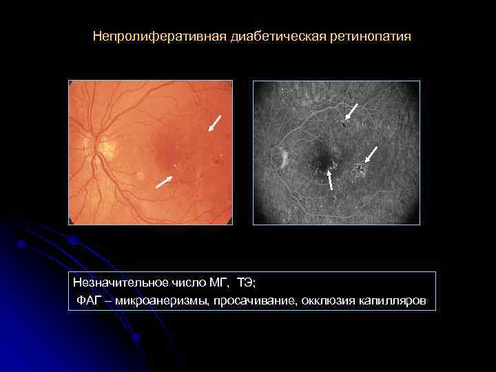 Непролиферативная диабетическая ретинопатия Незначительное число МГ, ТЭ; ФАГ – микроанеризмы, просачивание, окклюзия капилляров 