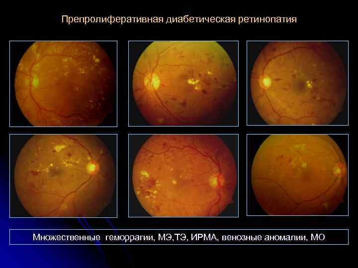 Препролиферативная диабетическая ретинопатия Множественные геморрагии, МЭ, ТЭ, ИРМА, венозные аномалии, МО 