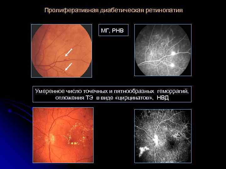 Пролиферативная диабетическая ретинопатия МГ, РНВ Умеренное число точечных и пятнообразных геморрагий, отложения ТЭ в