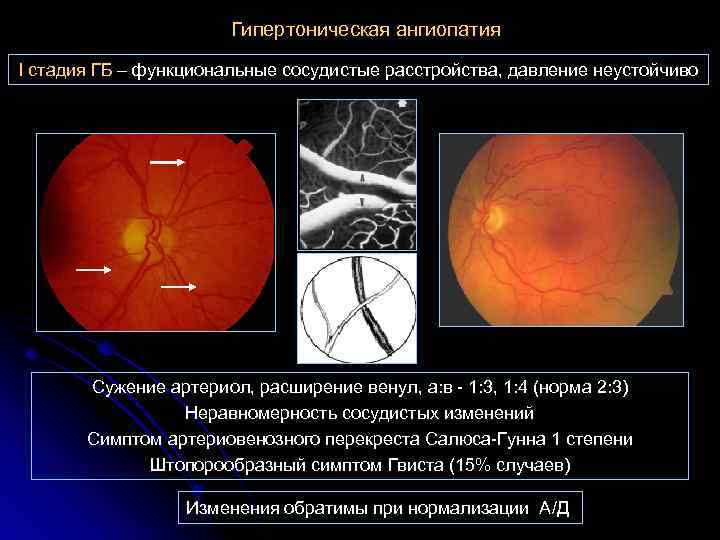 Гипертоническая ангиопатия I стадия ГБ – функциональные сосудистые расстройства, давление неустойчиво Сужение артериол, расширение