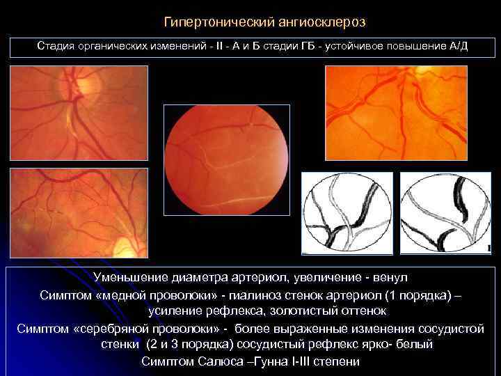 Гипертонический ангиосклероз Стадия органических изменений - II - А и Б стадии ГБ -