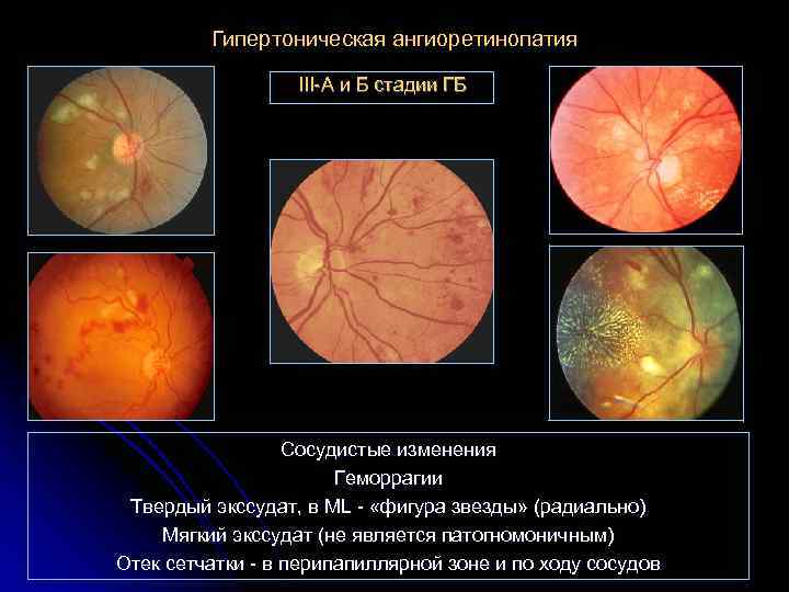 Гипертоническая ангиоретинопатия III-А и Б стадии ГБ Сосудистые изменения Геморрагии Твердый экссудат, в ML