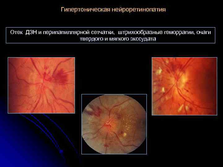 Гипертоническая нейроретинопатия Отек ДЗН и перипапиллярной сетчатки, штрихообразные геморрагии, очаги твердого и мягкого экссудата