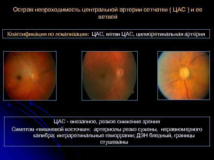 Острая непроходимость центральной артерии сетчатки ( ЦАС ) и ее ветвей Классификация по локализации: