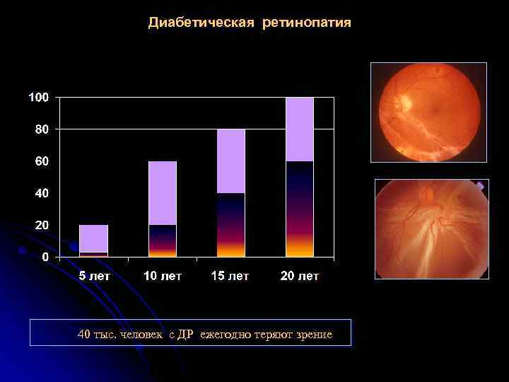 Диабетическая ретинопатия 40 тыс. человек с ДР ежегодно теряют зрение 