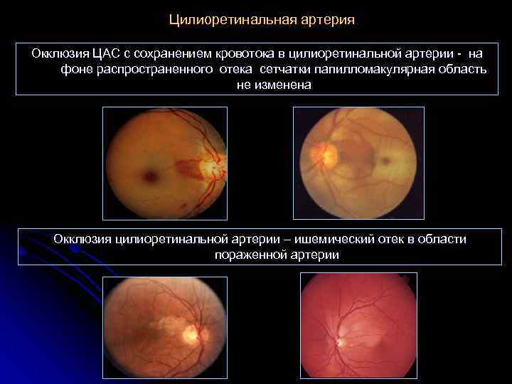 Цилиоретинальная артерия Окклюзия ЦАС с сохранением кровотока в цилиоретинальной артерии - на фоне распространенного