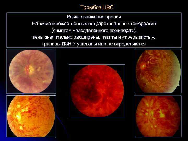 Тромбоз ЦВС Резкое снижение зрения Наличие множественных интраретинальных геморрагий (симптом «раздавленного помидора» ), вены