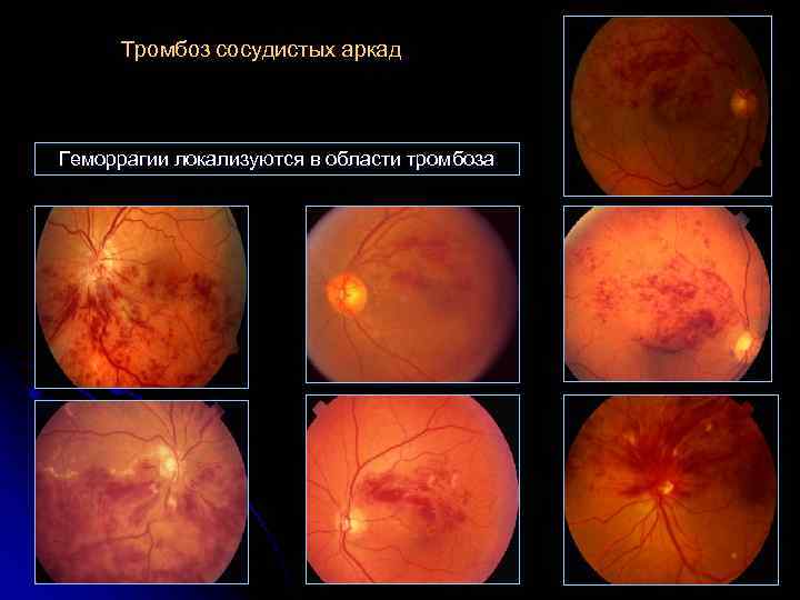 Тромбоз сосудистых аркад Геморрагии локализуются в области тромбоза 