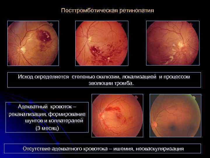 Посттромботическая ретинопатия Исход определяется степенью окклюзии, локализацией и процессом эволюции тромба. Адекватный кровоток –