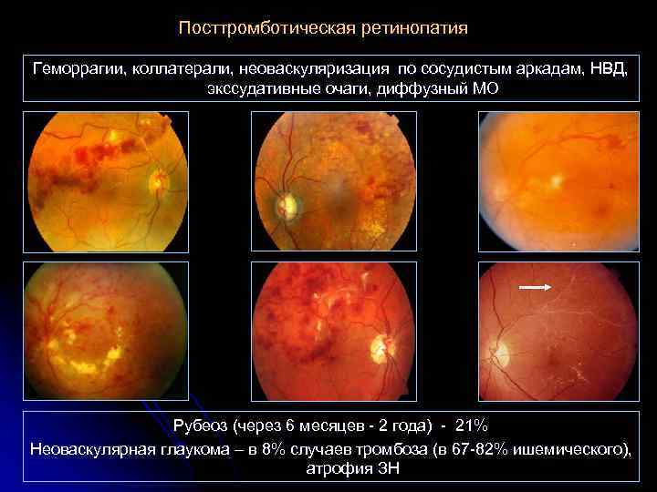 Посттромботическая ретинопатия Геморрагии, коллатерали, неоваскуляризация по сосудистым аркадам, НВД, экссудативные очаги, диффузный MO Рубеоз