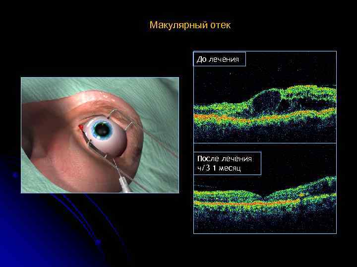 Макулярный отек До лечения После лечения ч/3 1 месяц 