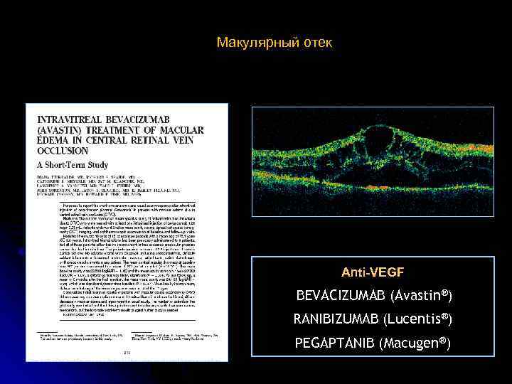 Макулярный отек Anti-VEGF BEVACIZUMAB (Avastin®) RANIBIZUMAB (Lucentis®) PEGAPTANIB (Macugen®) 