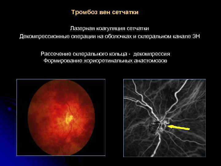 Тромбоз вен сетчатки Лазерная коагуляция сетчатки Декомпрессионные операции на оболочках и склеральном канале ЗН