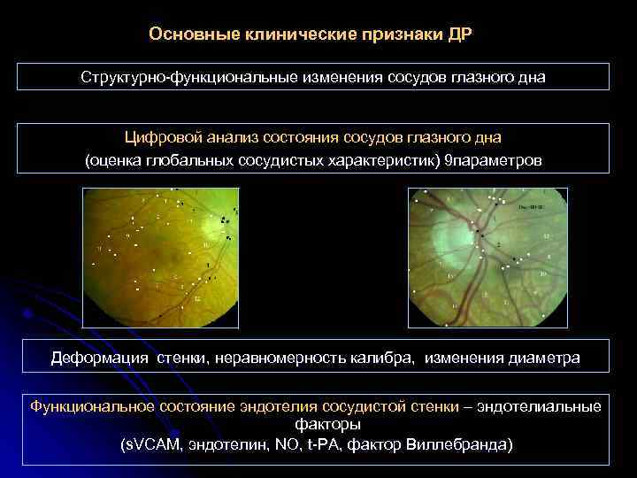 Основные клинические признаки ДР Структурно-функциональные изменения сосудов глазного дна Цифровой анализ состояния сосудов глазного