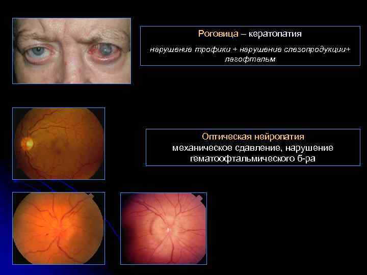 Роговица – кератопатия нарушение трофики + нарушение слезопродукции+ лагофтальм Оптическая нейропатия механическое сдавление, нарушение