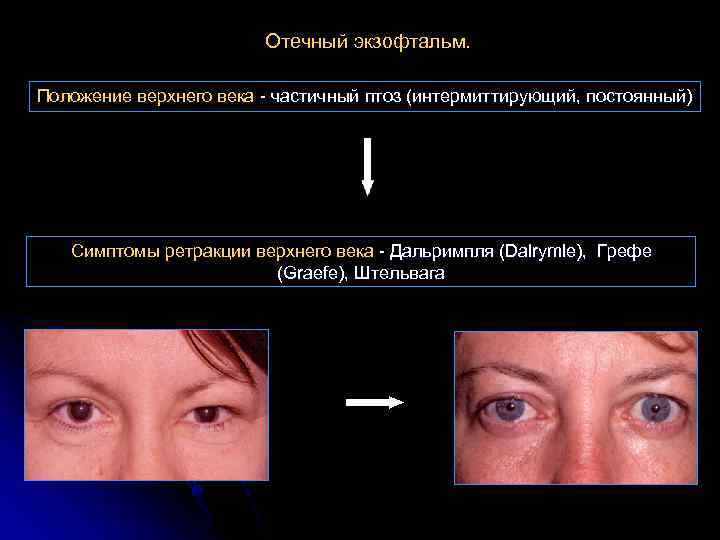 Отечный экзофтальм. Положение верхнего века - частичный птоз (интермиттирующий, постоянный) Симптомы ретракции верхнего века