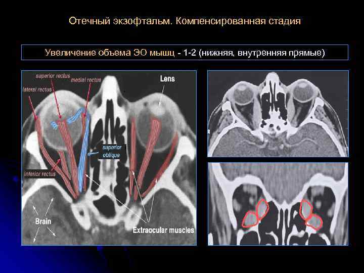 Отечный экзофтальм. Компенсированная стадия Увеличение объема ЭО мышц - 1 -2 (нижняя, внутренняя прямые)