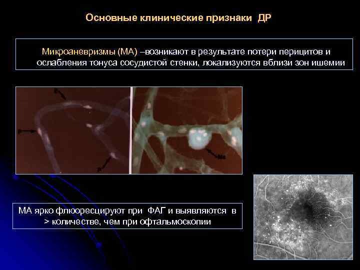 Основные клинические признаки ДР Микроаневризмы (МА) –возникают в результате потери перицитов и ослабления тонуса