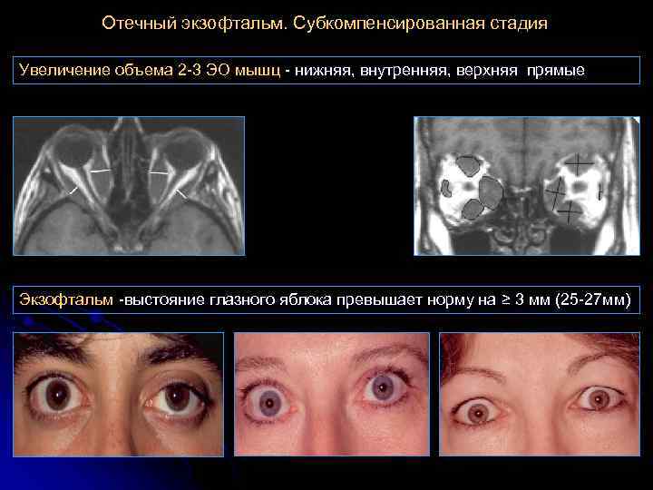 Отечный экзофтальм. Субкомпенсированная стадия Увеличение объема 2 -3 ЭО мышц - нижняя, внутренняя, верхняя