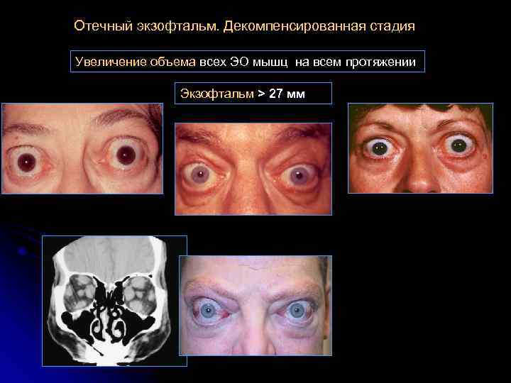 Отечный экзофтальм. Декомпенсированная стадия Увеличение объема всех ЭО мышц на всем протяжении Экзофтальм >