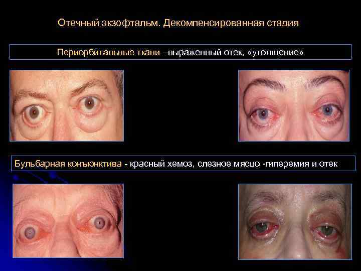 Отечный экзофтальм. Декомпенсированная стадия Периорбитальные ткани –выраженный отек, «утолщение» Бульбарная конъюнктива - красный хемоз,