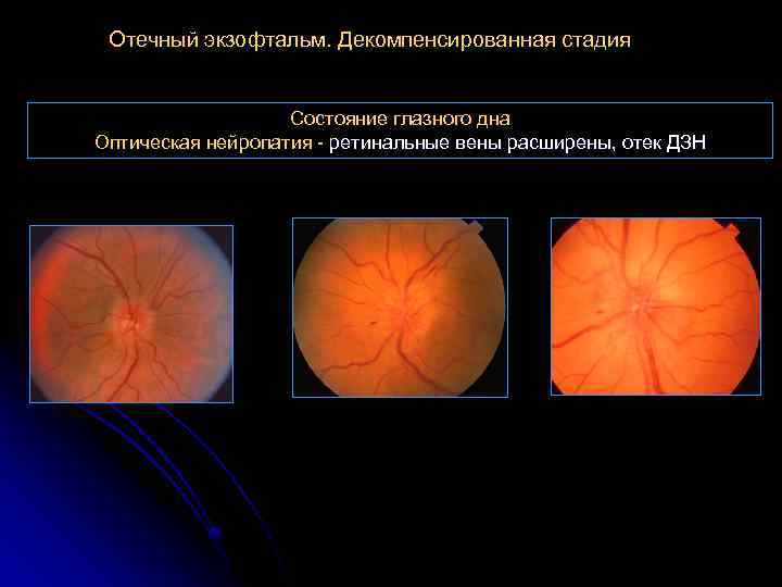 Отечный экзофтальм. Декомпенсированная стадия Состояние глазного дна Оптическая нейропатия - ретинальные вены расширены, отек